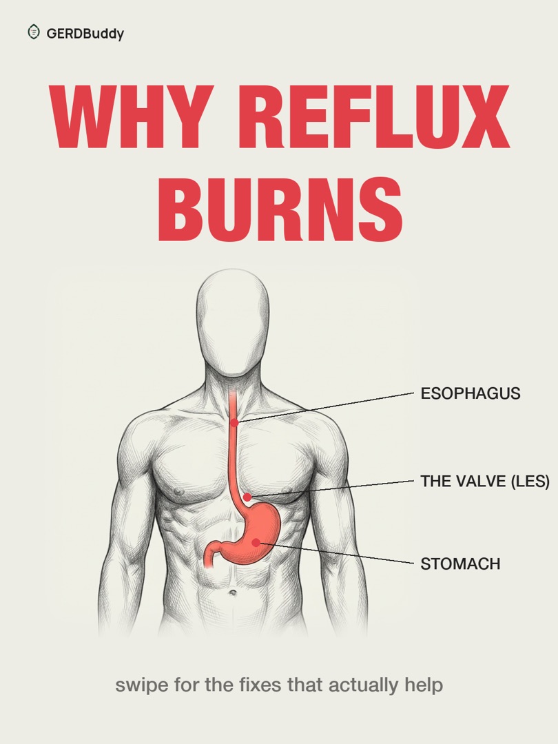 Why reflux burns: the esophagus, the valve (LES) and the stomach